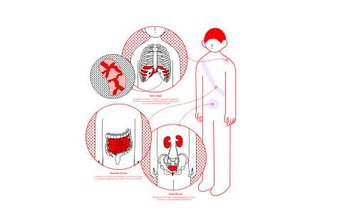 Internal Hemorrhage From Blunt Trauma